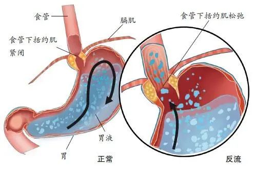 吃完饭「泛酸」的人，食管默默承受患癌风险……740 / 作者:健康小天使 / 帖子ID:293277