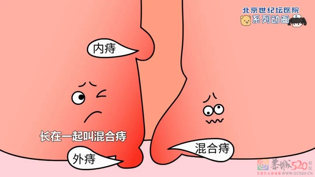 春天，也是痔疮的“春天”！肛肠科医生喊你提肛打卡872 / 作者:健康小天使 / 帖子ID:293302