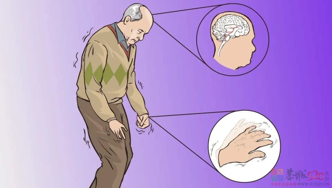帕金森病有个“迹象拼图”，协和医生推荐6个动作自测1000 / 作者:健康小天使 / 帖子ID:294407