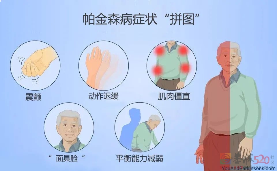帕金森病有个“迹象拼图”，协和医生推荐6个动作自测753 / 作者:健康小天使 / 帖子ID:294407
