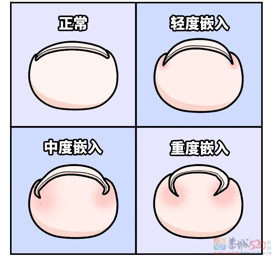剪指甲的一个错误习惯，让很多人痛苦不堪237 / 作者:健康小天使 / 帖子ID:295200