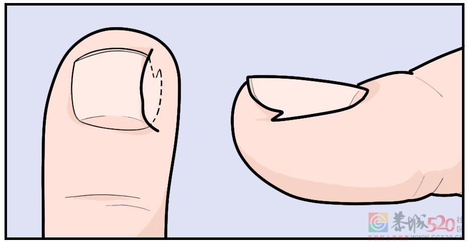 剪指甲的一个错误习惯，让很多人痛苦不堪30 / 作者:健康小天使 / 帖子ID:295200