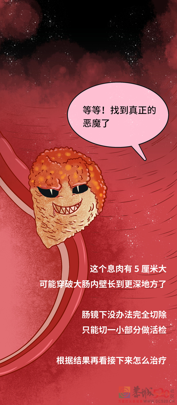 发现就是中晚期的肠癌，一个方法可以避免207 / 作者:健康小天使 / 帖子ID:296541