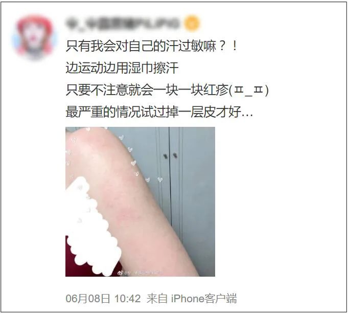 “对自己的汗过敏”不是玩笑话，给荨麻疹患者的8个建议762 / 作者:健康小天使 / 帖子ID:296606