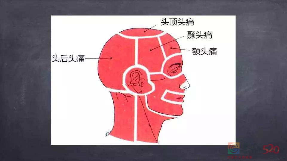 你经常硬扛的「偏头痛」，其实是第二大致残原因611 / 作者:健康小天使 / 帖子ID:296917