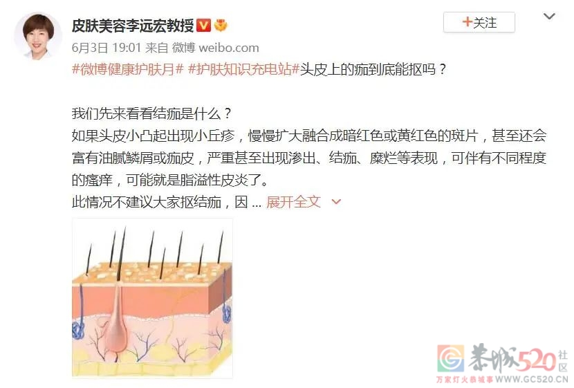 头皮经常长「痂」的人，是时候管管这种真菌了……836 / 作者:健康小天使 / 帖子ID:297034