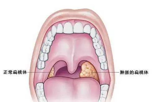 除了发炎，「扁桃体」还能干什么？409 / 作者:健康小天使 / 帖子ID:297740