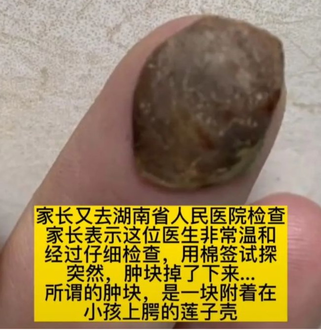 如此医院你说黑不黑？小孩喉咙粘的莲子壳诊断为恶性肿瘤！940 / 作者:平安大叔 / 帖子ID:299216