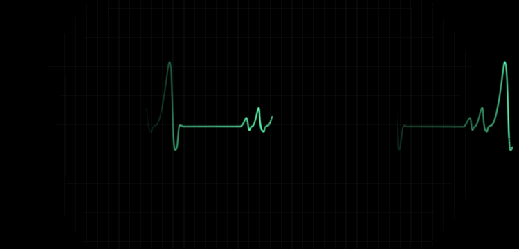 5年运动猝死事件数据告诉你，这三类运动最“危险”750 / 作者:健康小天使 / 帖子ID:299470