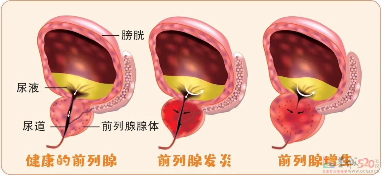健康男人的“标准时长”：小便30秒左右535 / 作者:健康小天使 / 帖子ID:306174