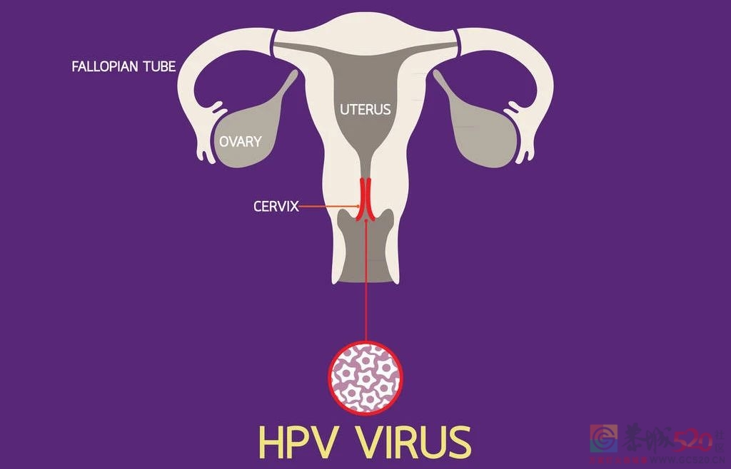 女性一生感染HPV几率高达80%！多数人两年内可“自愈”359 / 作者:健康小天使 / 帖子ID:306645