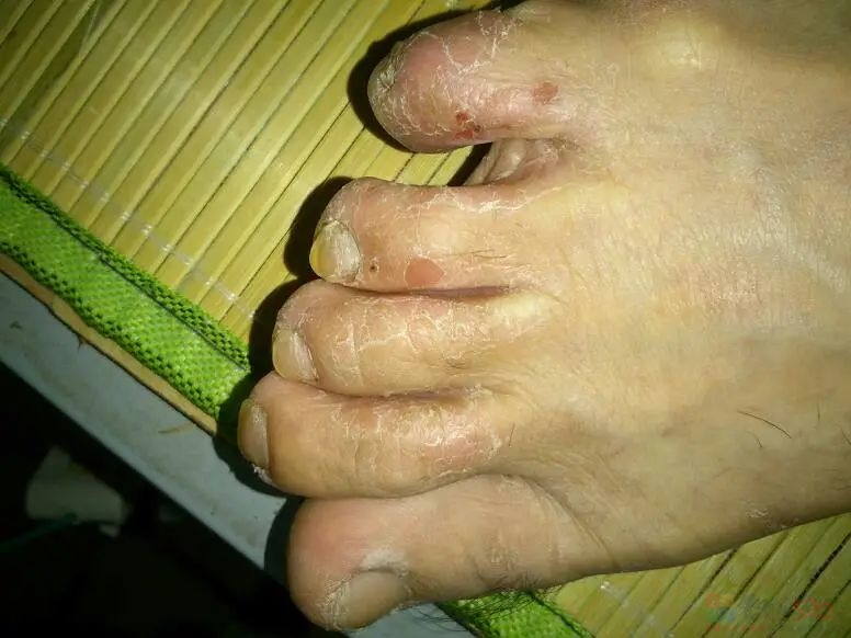 夏季实用帖：劝你在天热前治好脚气……758 / 作者:健康小天使 / 帖子ID:307145