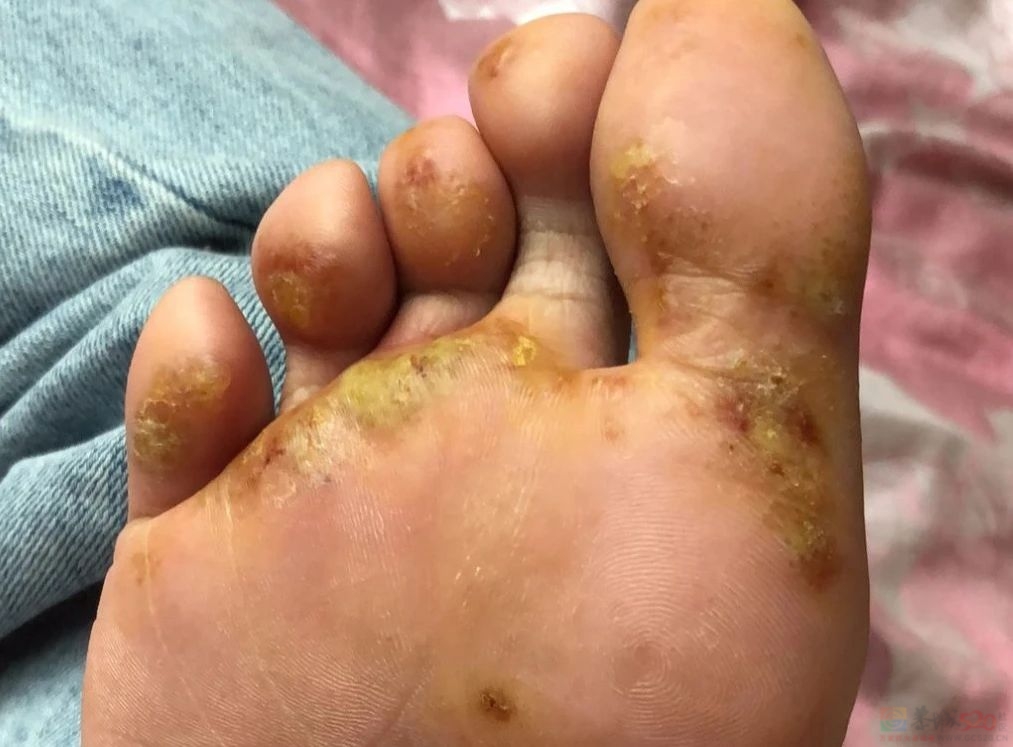 夏季实用帖：劝你在天热前治好脚气……978 / 作者:健康小天使 / 帖子ID:307145
