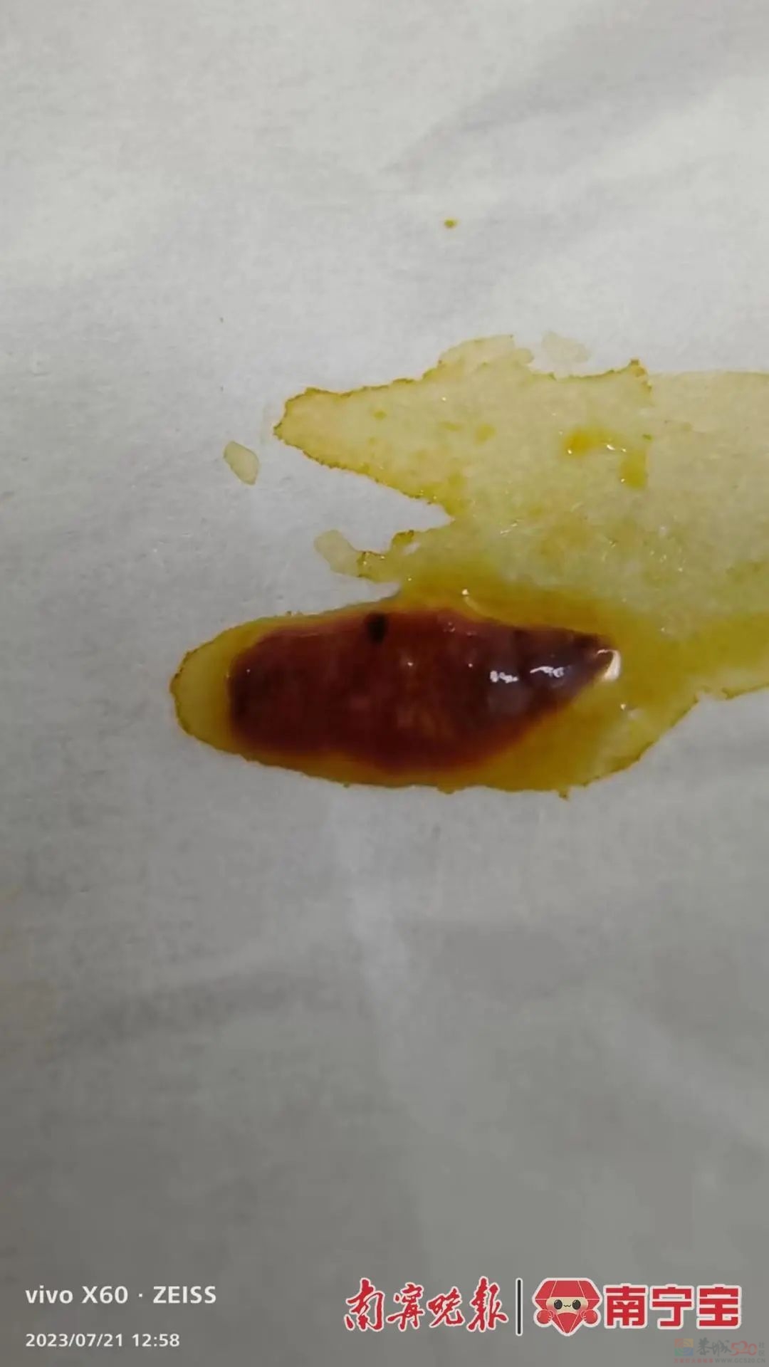 头皮发麻！广西一女子体内惊现大量“瓜子”活虫，只因这个习惯……331 / 作者:健康小天使 / 帖子ID:308769