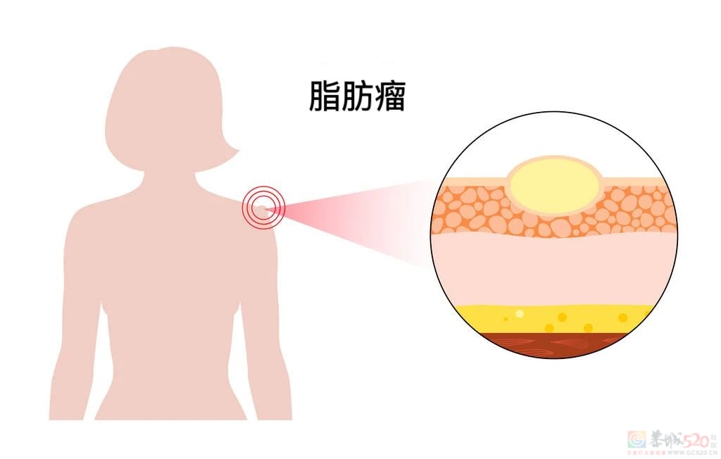 不痛不痒的“脂肪瘤”，需要治疗吗？610 / 作者:健康小天使 / 帖子ID:308939