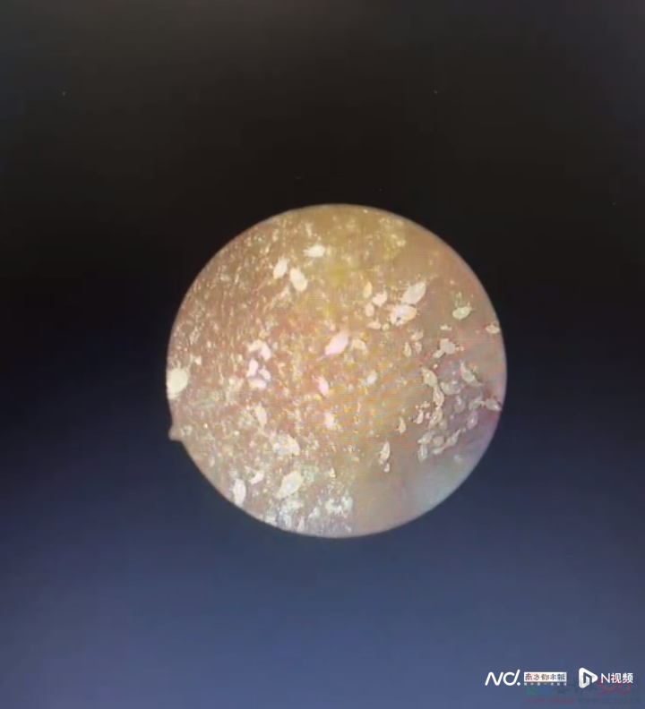 男子耳朵奇痒无比，医生一看：全是虫……673 / 作者:健康小天使 / 帖子ID:309183