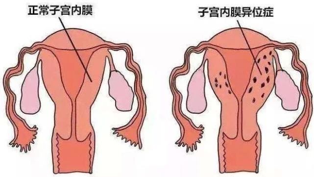经常痛经的人有救了：90%可以用4种药缓解553 / 作者:健康小天使 / 帖子ID:309441