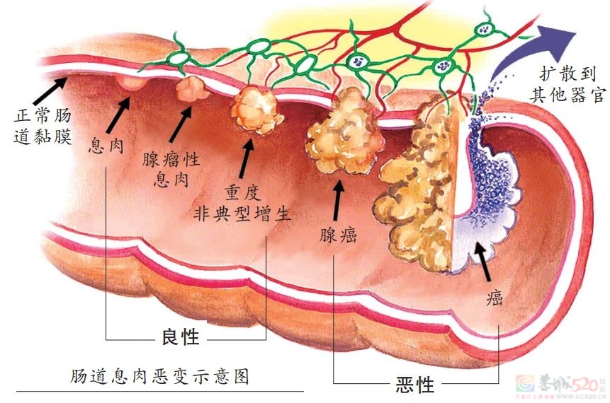 为什么一发现肠息肉就要切除？这3种息肉易癌变20 / 作者:健康小天使 / 帖子ID:313310