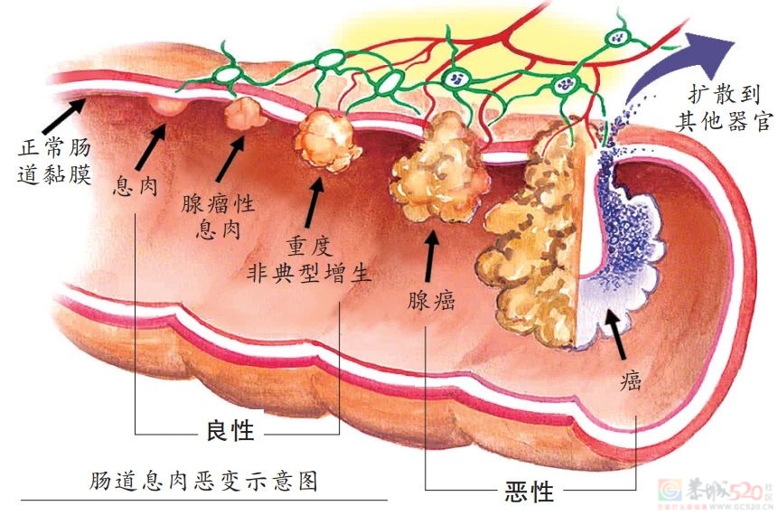 为什么一发现肠息肉就要切除？这3种息肉易癌变522 / 作者:健康小天使 / 帖子ID:313310