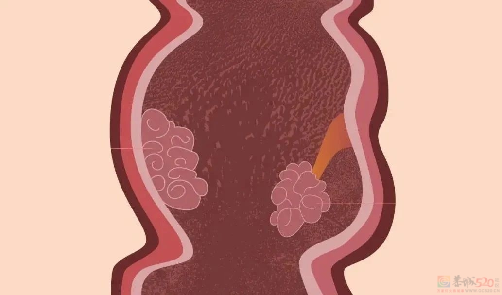 为什么一发现肠息肉就要切除？这3种息肉易癌变283 / 作者:健康小天使 / 帖子ID:313310