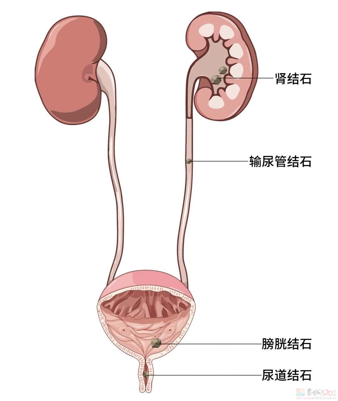 过年这样吃，小心腰痛生“石”，严重没命！6种人特别要小心619 / 作者:健康小天使 / 帖子ID:313599