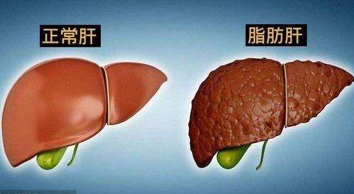 “饿肚子”能改善脂肪肝，前提是在这个时段482 / 作者:健康小天使 / 帖子ID:317163