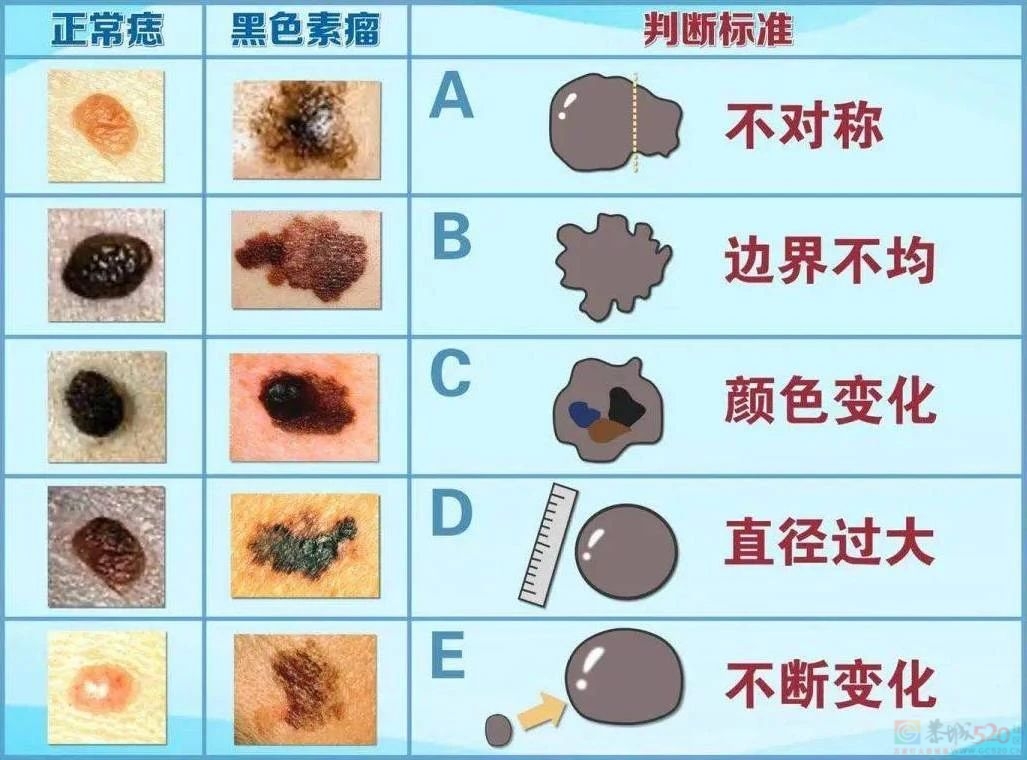 会癌变的“痣”，有这5个特征276 / 作者:健康小天使 / 帖子ID:318390
