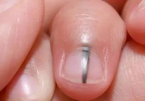 会癌变的“痣”，有这5个特征248 / 作者:健康小天使 / 帖子ID:318390